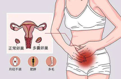 双侧卵巢多囊样改变能怀孕吗？要怎么办才好？